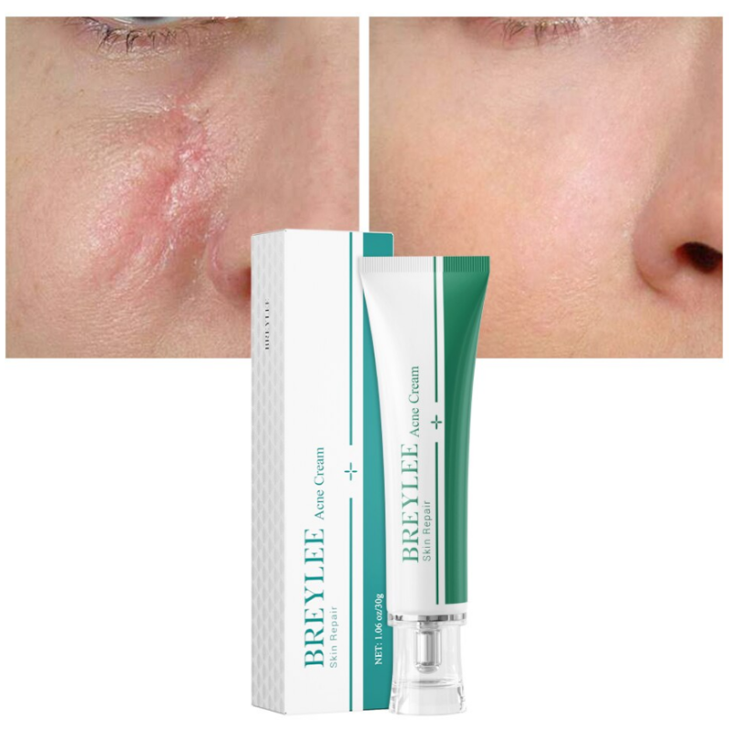 Крем для видалення шрамів і рубців від висипу вугрів Breylee Acne Scar Removal Cream