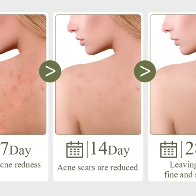 Натуральне мило для лікування акне,  прищів та вугрів з олією чайного дерева